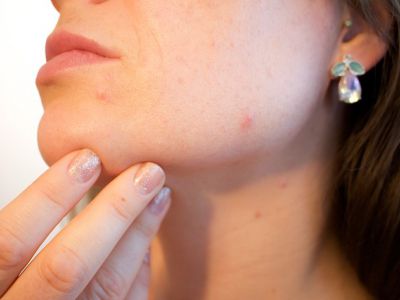 Des produits pour lutter efficacement contre l'acné